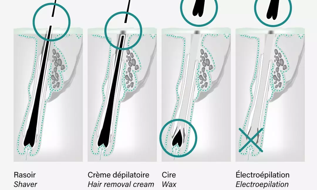 One, Six, or Ten 30 or 60-Minute Electrolysis Sessions