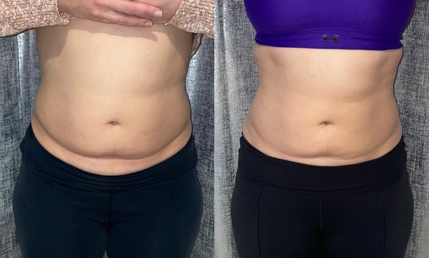 Image 3: Noninvasive ultrasonic cavitation sessions to target stubborn fat