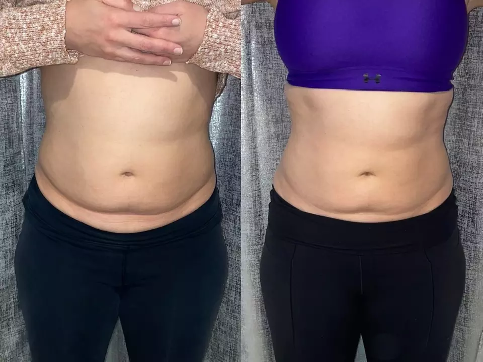 Noninvasive ultrasonic cavitation sessions to target stubborn fat