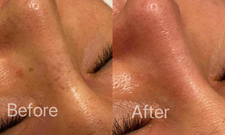 Image 2: One or Three Pico Laser Session for Up to 0.5" x 0.5" or 1" x 1"