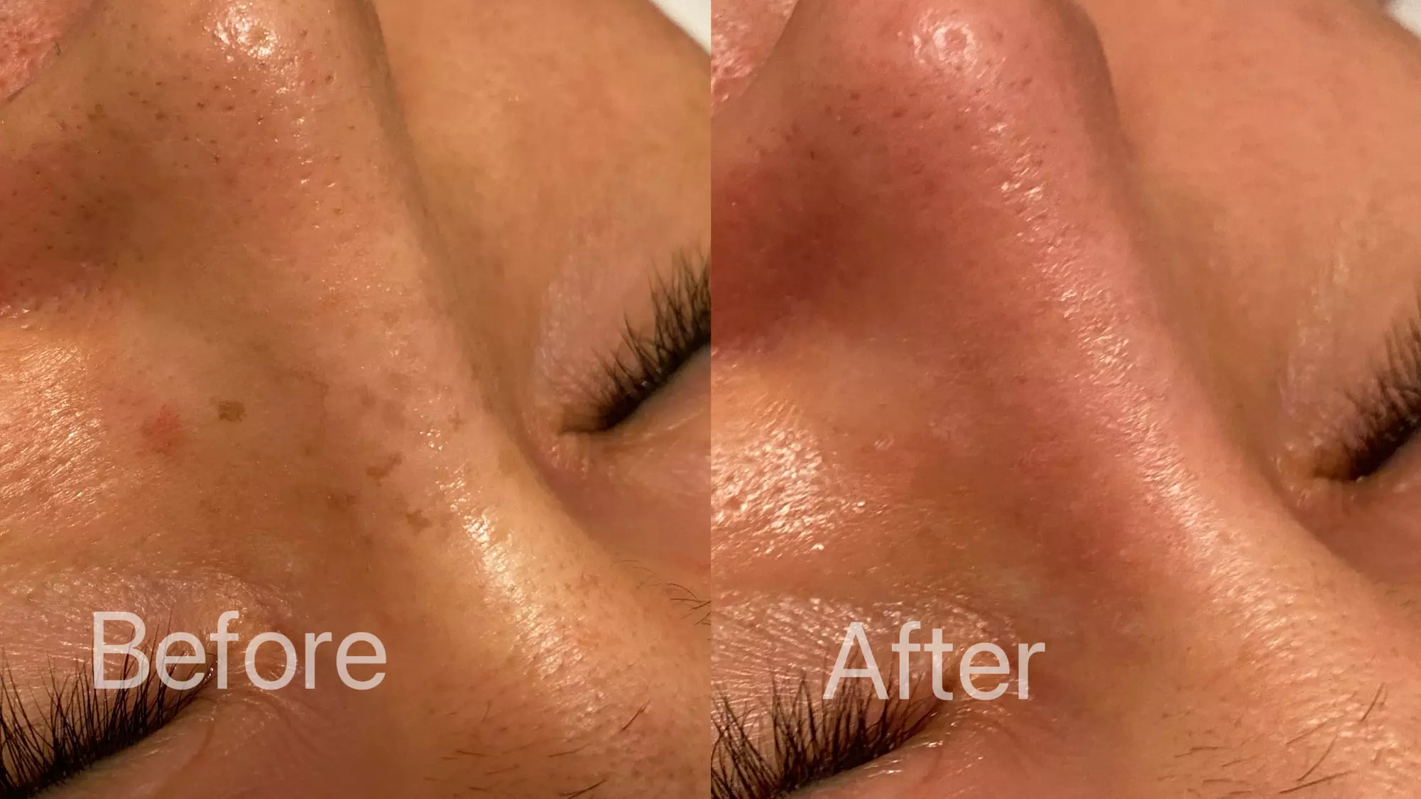 One Pico Laser Session for an Area Up to 0.5" x 0.5" or One or Three Sessions on Up to 1" x 1" ( Up to 80% Off ) - Second Medium