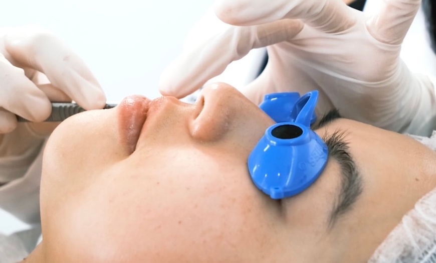 Image 2: One 60 or 75 -Minute Microdermabrasion Treatment