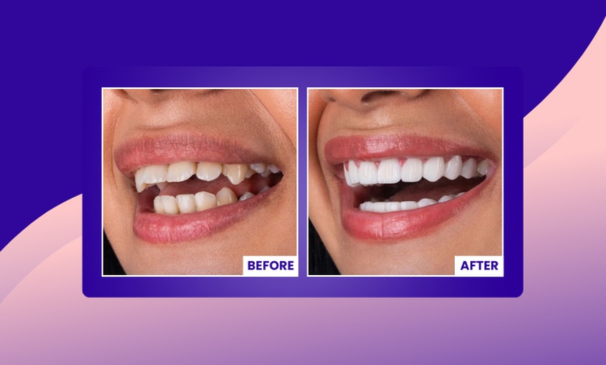 Image 2: Up to 67% Off on Invisible Aligners - StarSmiles Aligners