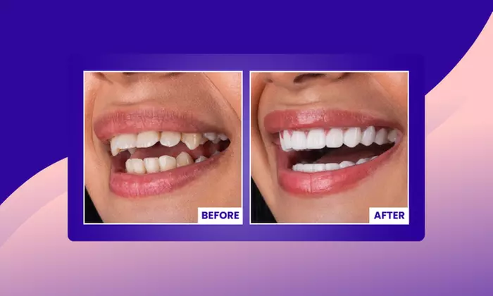 Up to 67% Off on Invisible Aligners - StarSmiles Aligners