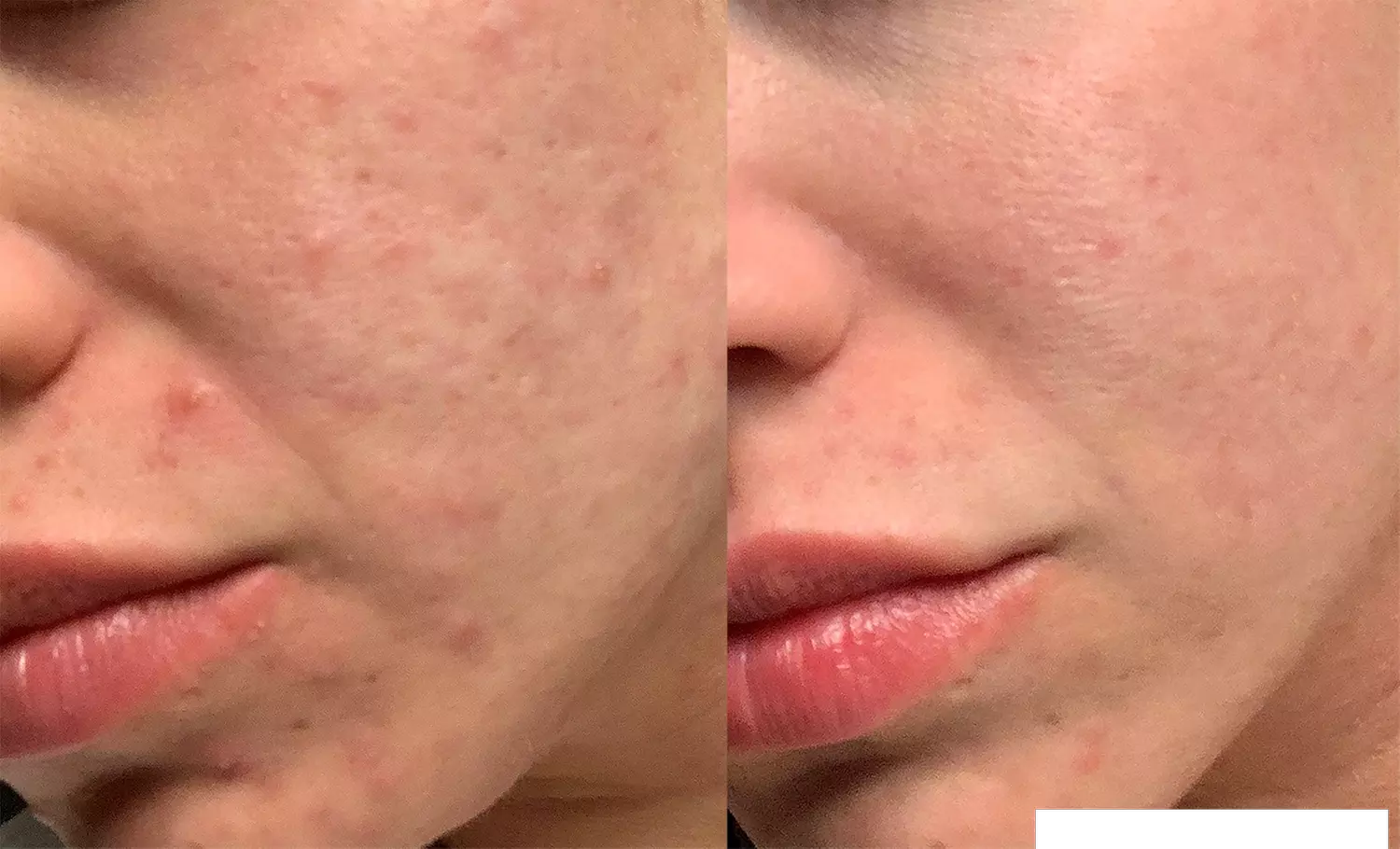 Get One or Two Morpheus8 Sessions w/ Optional 20 or 40 Units of Xeomin