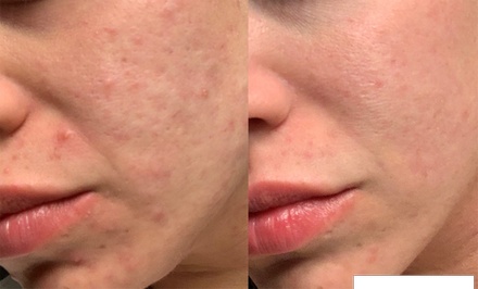 One Morpheus8 Session - SureMED Aesthetics