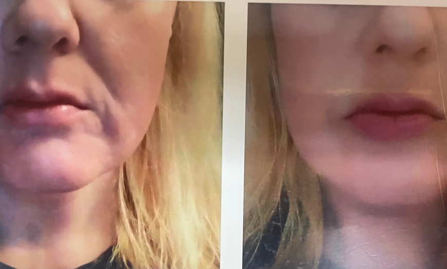 Image 4: 1, 2, or 3 Sessions RF Skin Tightening, Microdermabrasion &  Peel 