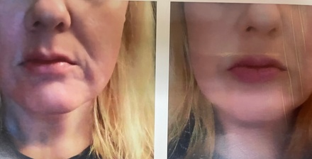 One Session - Radio Frequency Skin Tightening + Microdermabrasion + Lactic Peel - Bellissimo You
