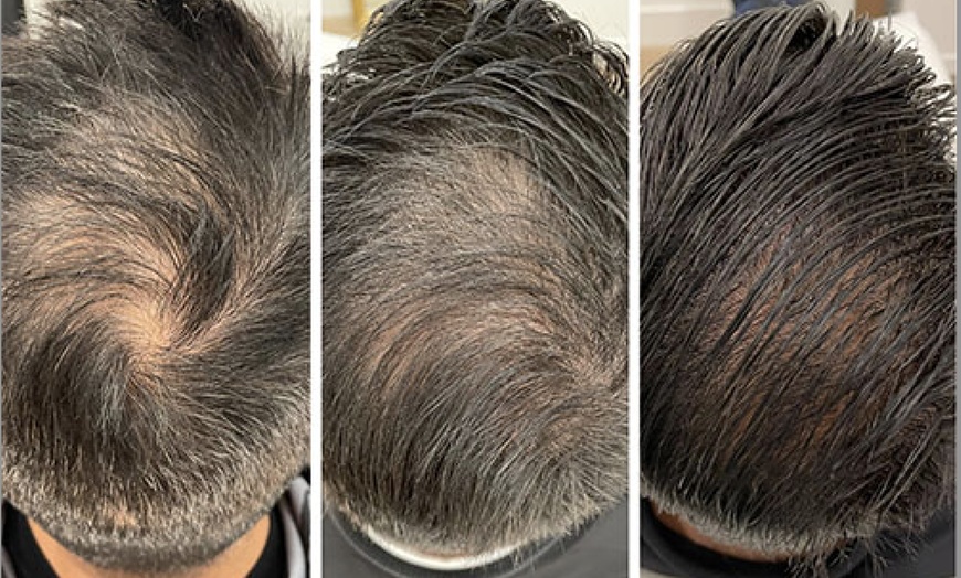 Image 5: 1, 2, or 3 Exosome Stem Cell or Hair Restoration w/ Thulium RF & More