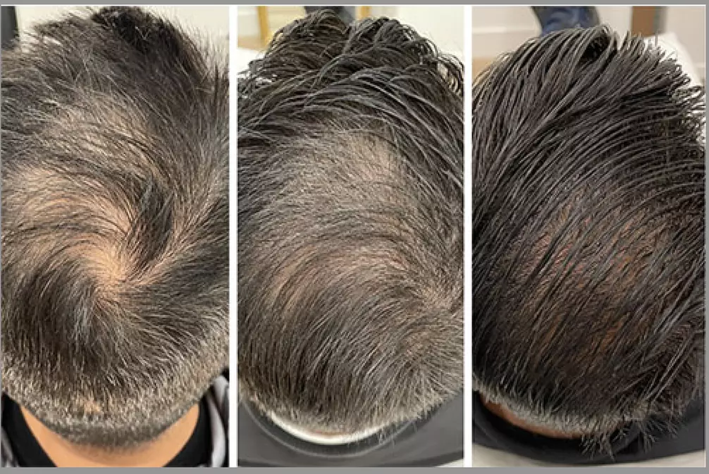 1, 2, or 3 Exosome Stem Cell or Advanced Hair Restoration Therapy with Thulium RF & Mesotherapy (Up to 40% Off) - Second Medium