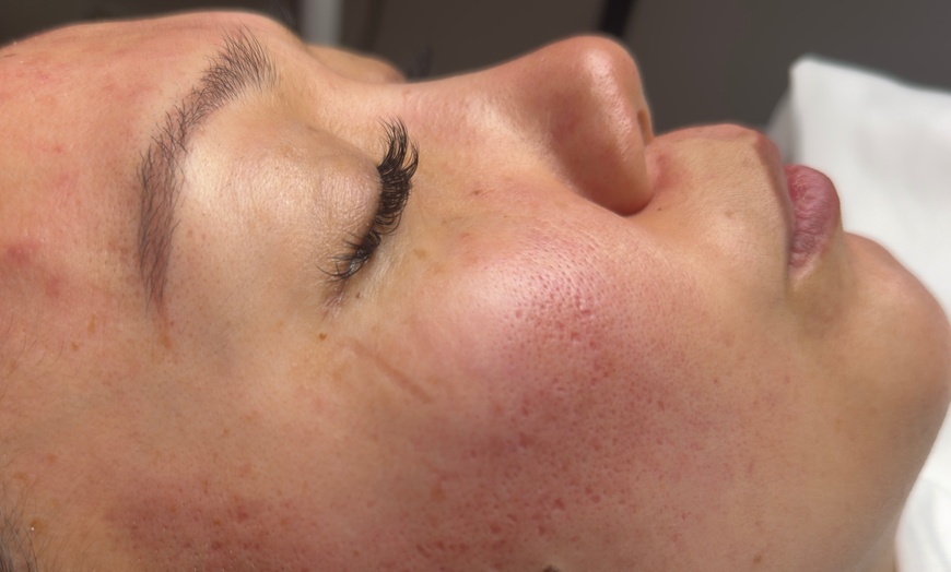 Image 6: Luxury Exosome Mesotherapy with PDRN for Skin Repair & Radiance