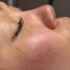 Image 6: Luxury Exosome Mesotherapy with PDRN for Skin Repair & Radiance