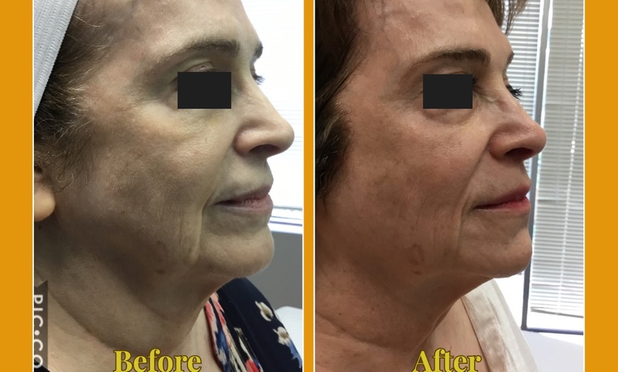 Image 4: Ultherapy Prime Treatment with for Face, Neck and Chest 