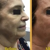 Image 4: Ultherapy Prime Treatment with for Face, Neck and Chest 
