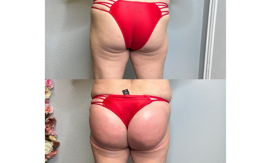 Image 2: Boost Your Confidence with 30, 60, or 90-Minute Non-Invasive Butt Lift