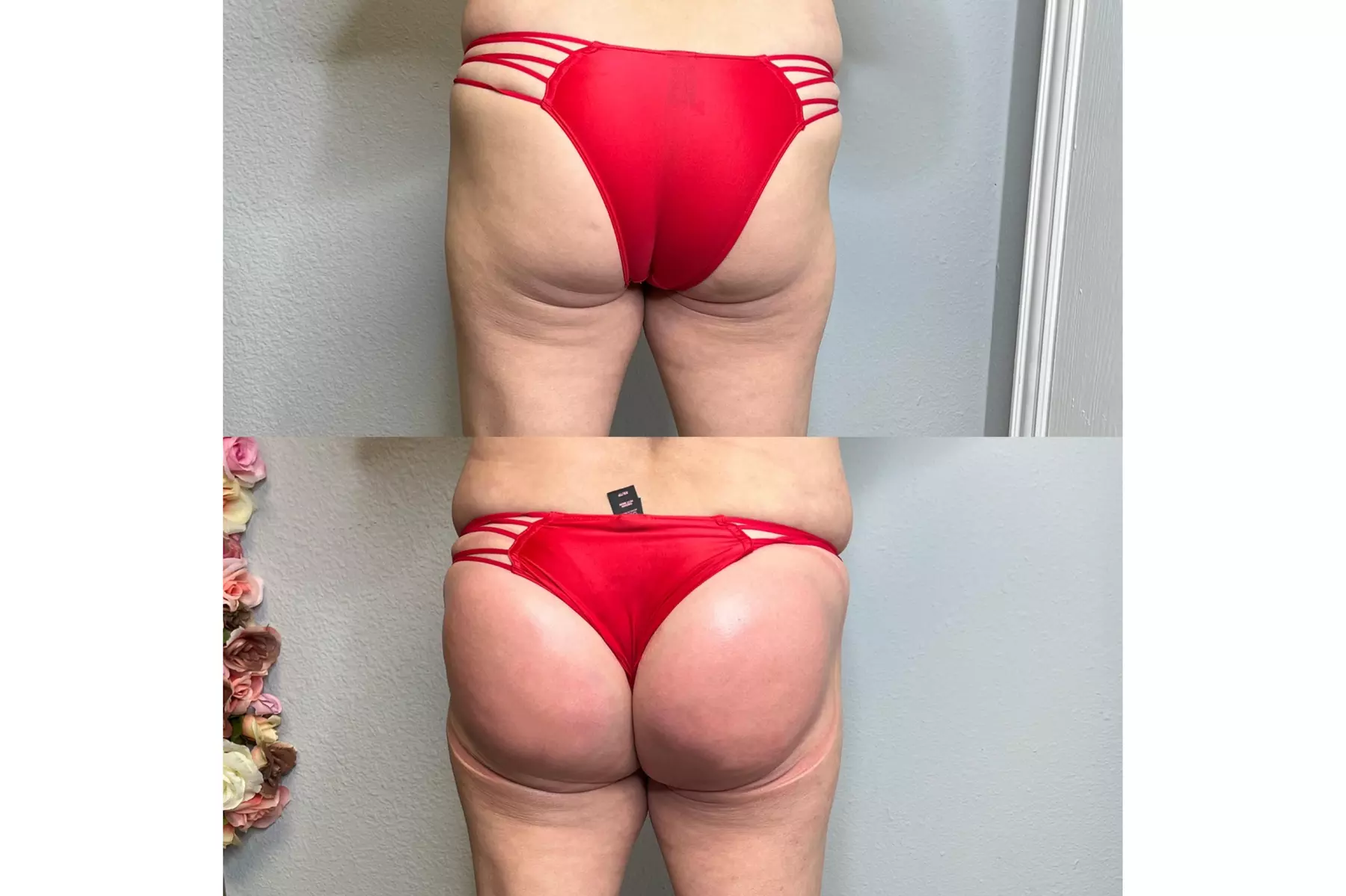 Boost Your Confidence with 30, 60, or 90-Minute Non-Invasive Butt Lift