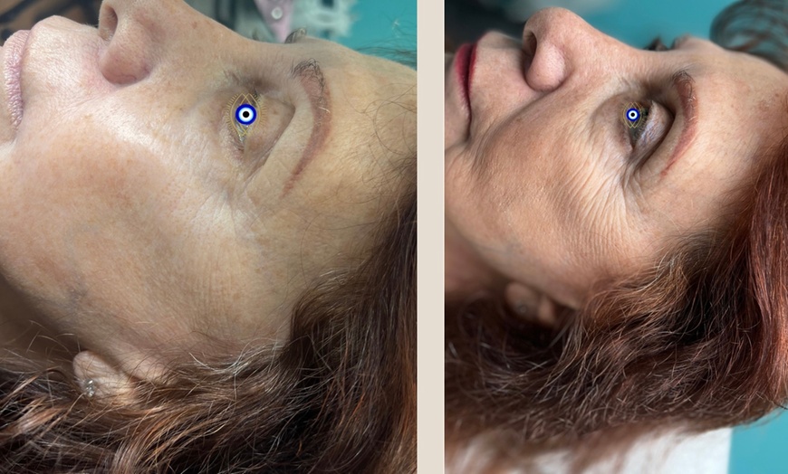 Image 1: Up to 38% Off on Facelift - Non-Surgical at Aesthetics Care Med Spa