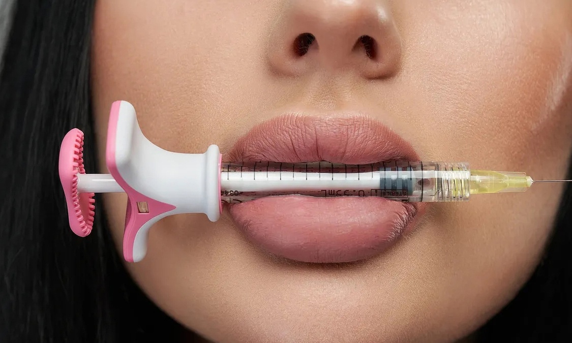 Enhance Your Looks with 1/2, 1ml or 2ml of Filler for Lips or Face