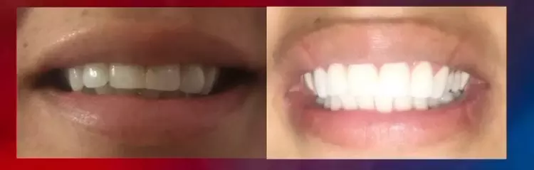 Experience Bright Smiles with Teeth Whitening at Camp Sacramento Aesthetics, Choose from 1 to 3 Treatments Up to 50% Off - Second Medium