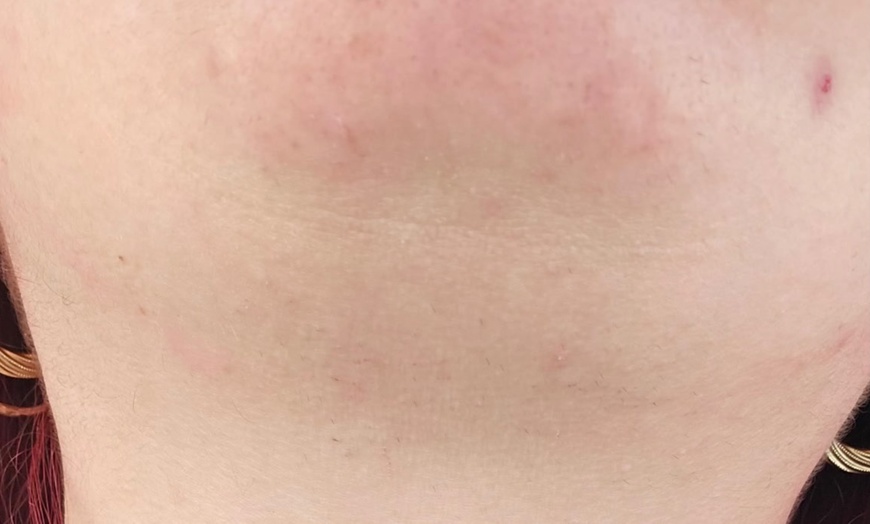 Image 2: 30-, 45- or 60-Minute Electrolysis Hair Removal Session + Consultation