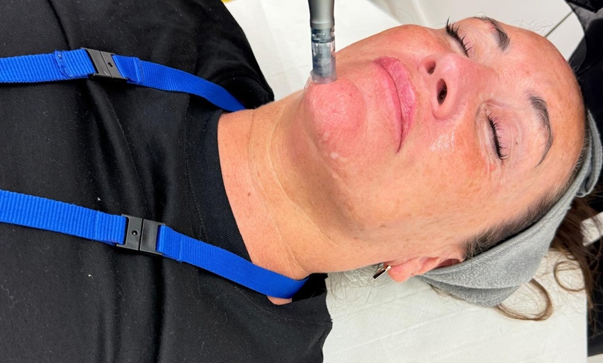 Image 1: Up to 35% Off on Micro-Needling at Viola Aesthetics Ltd