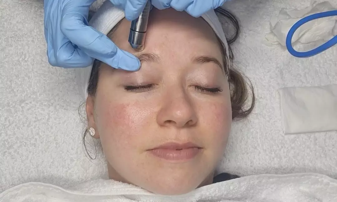 Skin Exfoliation and Microneedling Treatments
