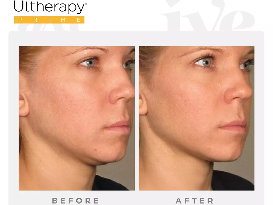 Ultherapy Prime - Full or Half Face & Neck Ultrasound at IVE MEDICAL SPA (Up to 50% Off) - Primary Image