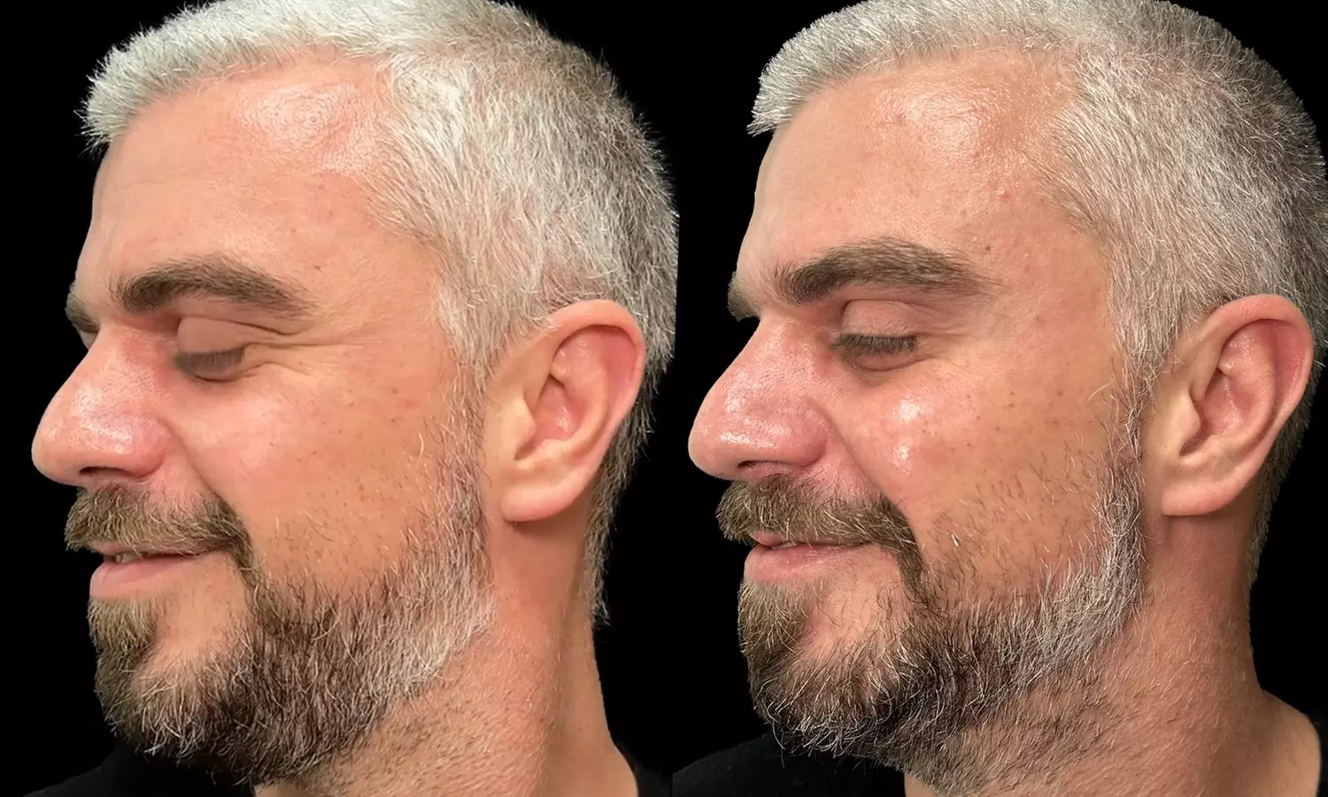 Smooth Away Lines with Botox Lip Flip, 20 or 40 Units of Botox