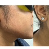 Image 4: Up to 40% Off on Laser Hair Removal at Bella Medical Aesthetics