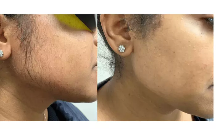 Up to 58% Off on Laser Hair Removal at Bella Medical Aesthetics