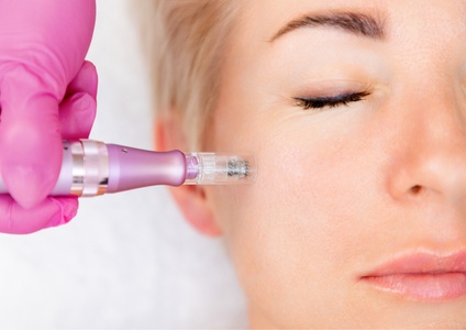 Microneedling with Stem Cell Treatment - Doll Haus Aesthetics