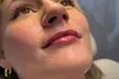 20, 40 or 60 Units of Botox or 1 ML Syringe Versa at Logica Aesthetics (Up to 35% Off) - Second Medium