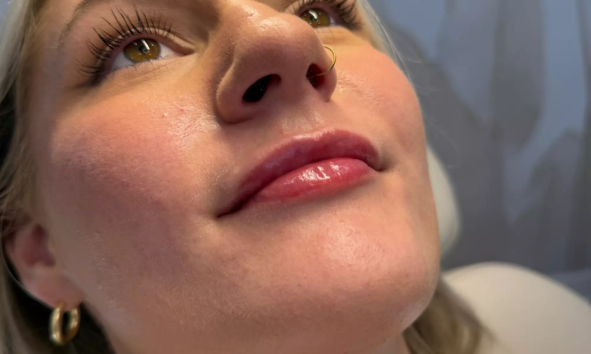 20, 40 or 60 Units of Botox or 1 ML Syringe Versa