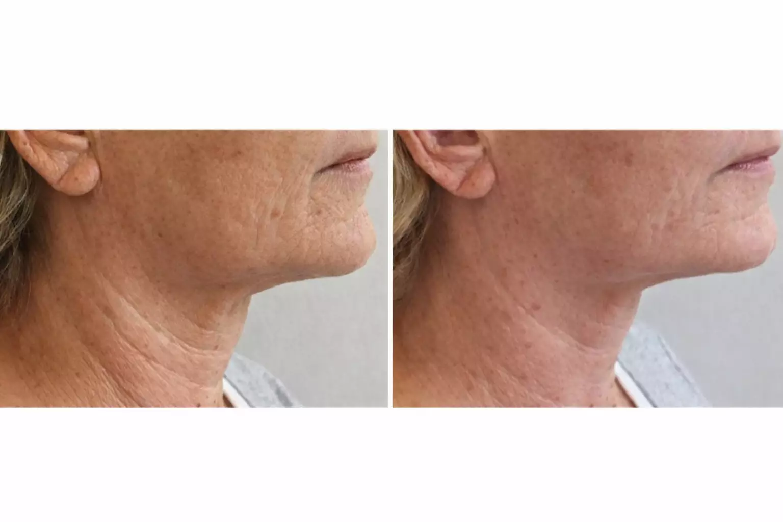 Full Face, Neck and Décolletage New Technology HIFU Treatment