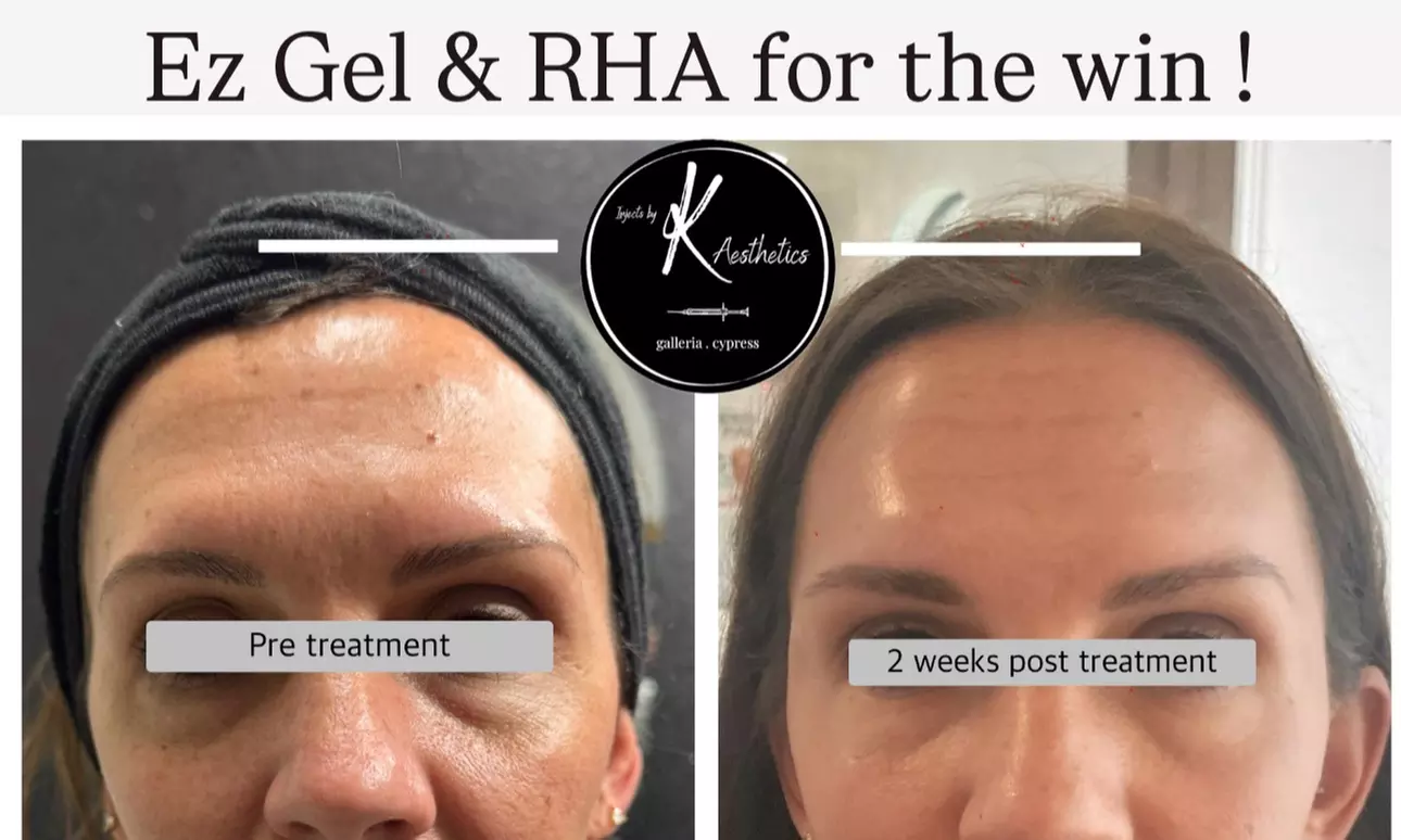 PRF -Liquid for Under Eyes / Organic Filler / PRF- EZ Gel