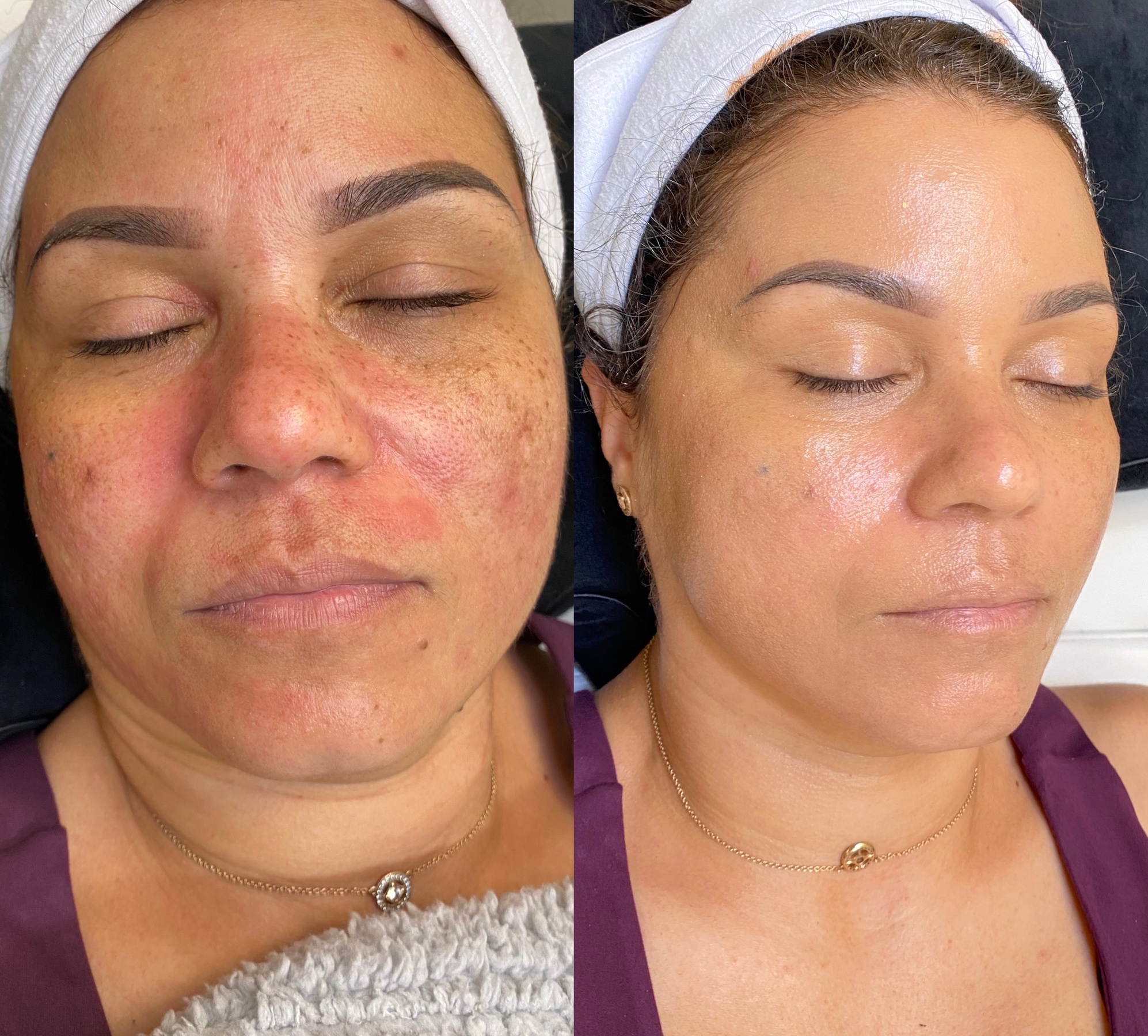 Transform Your Skin with Microdermabrasion and PRP Facials