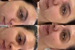 One Session Microneedling with Sheet Mask, Hyaluronic or Skin Booster at Glow Aesthetics By Jess - Image 3