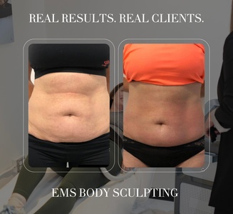 1 EMS Body Sculpting Sessions with RF Skin Tightening at Lux Body Space (abs, buttocks or pelvic floor area) - Lux Body Space