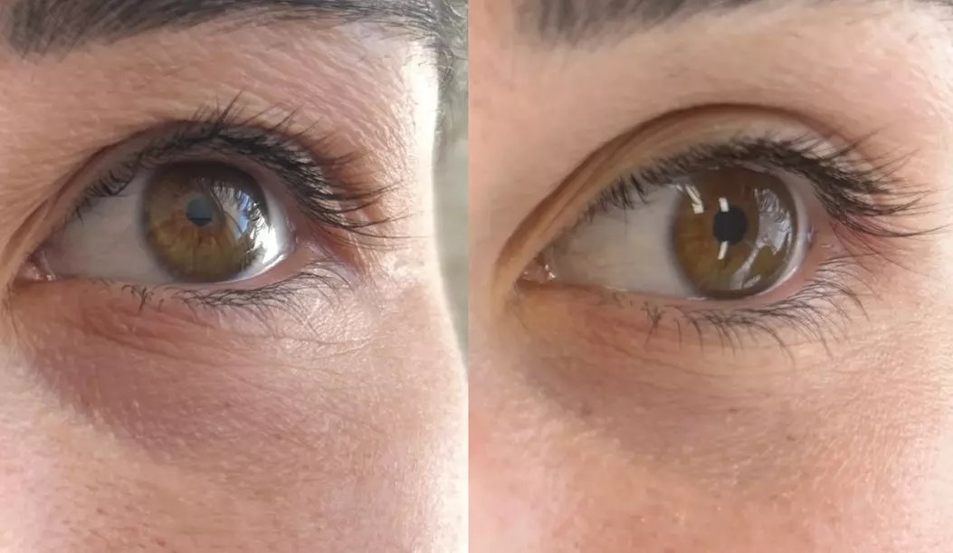 Rejuran Eye Skin Booster for Under-Eye Rejuvenation