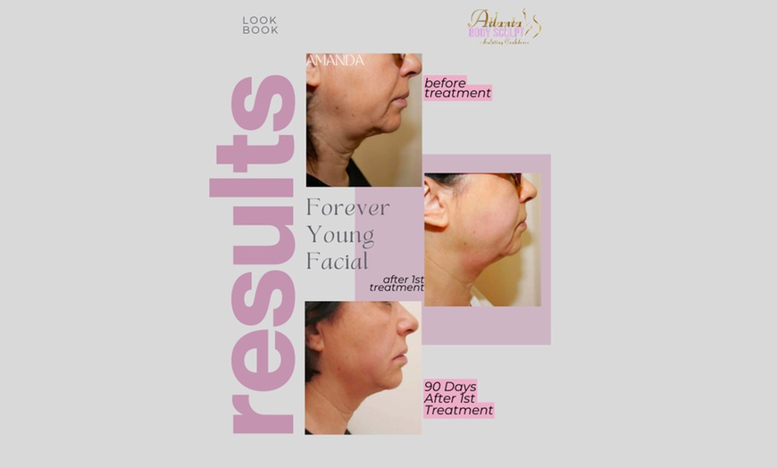 Image 6: Therma-Lift Facelifts for Youthful Skin with No Downtime