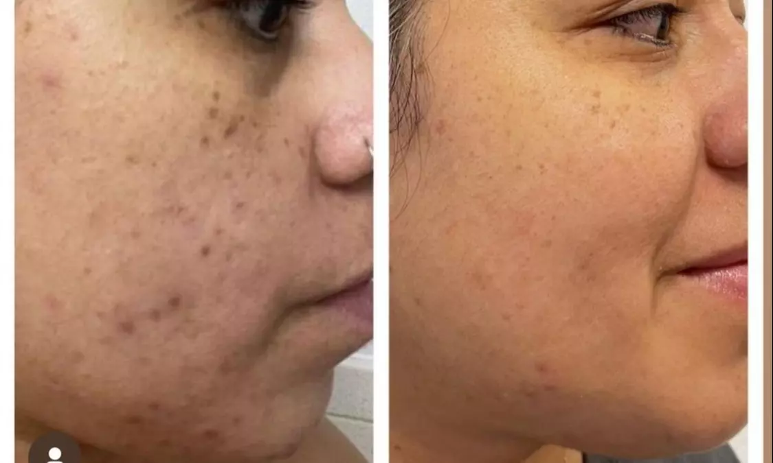 Up to 60% Off on Injection - Plasma at Beauty_Lash_LLC - Primary Image