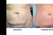 Experience Rewind Advanced Aesthetics'  Skin Tightening for Stomach, Eyes, Neck, or Knees (Up to 37% Off) - Second Medium