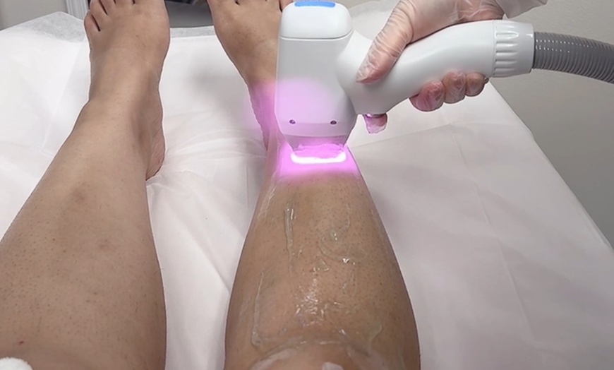 Image 3: Up to 50% Off on Laser Hair Removal at Sara Aesthetics LLC