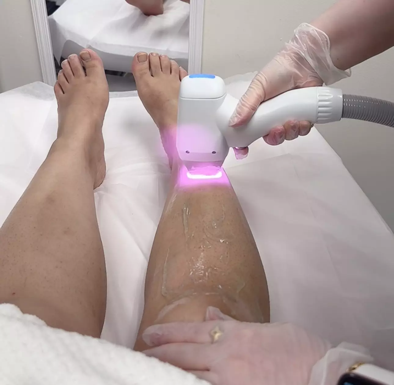 Up to 31% Off on Laser Hair Removal at Sara Aesthetics LLC