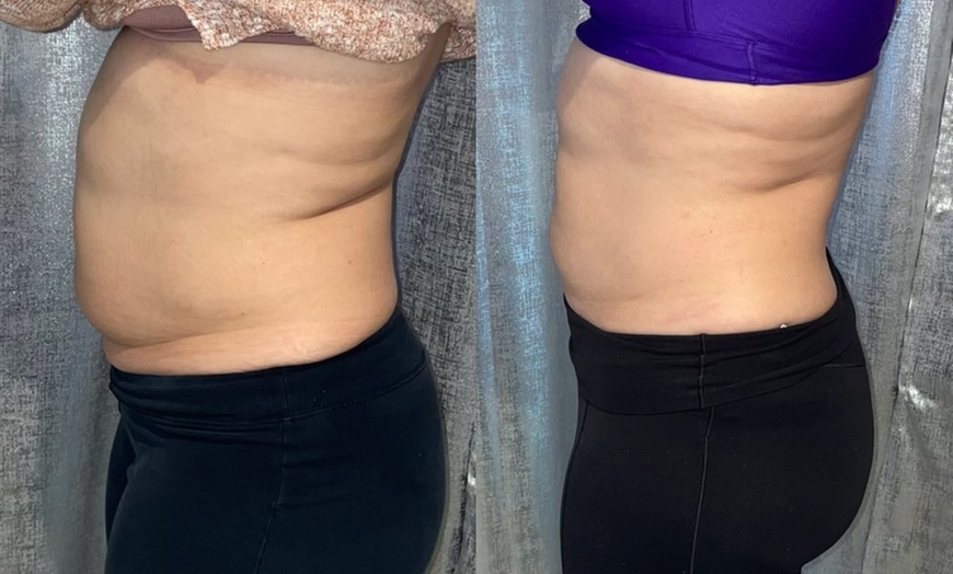Image 4: Noninvasive ultrasonic cavitation sessions to target stubborn fat