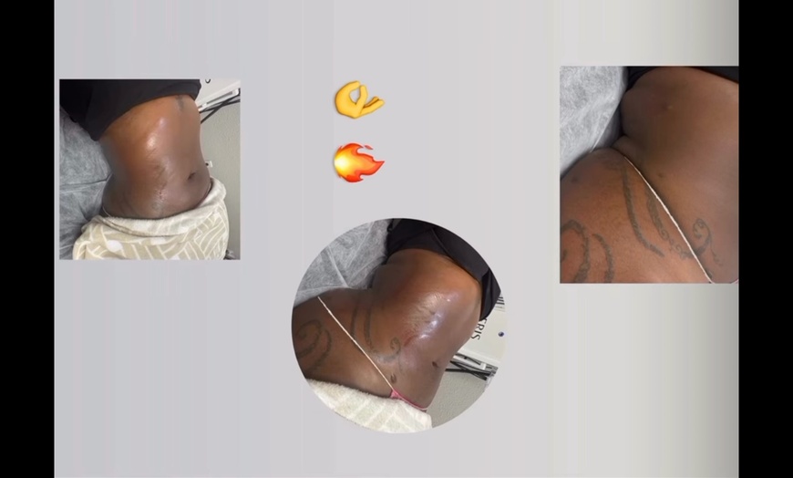 Image 3: Targeted Fat Reduction – Non-Invasive Laser Lipo Session