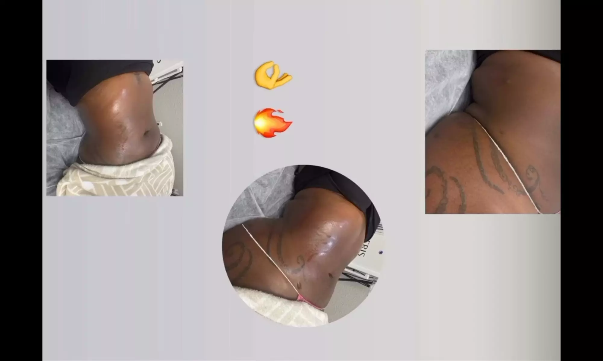 Targeted Fat Reduction – Non-Invasive Laser Lipo Session