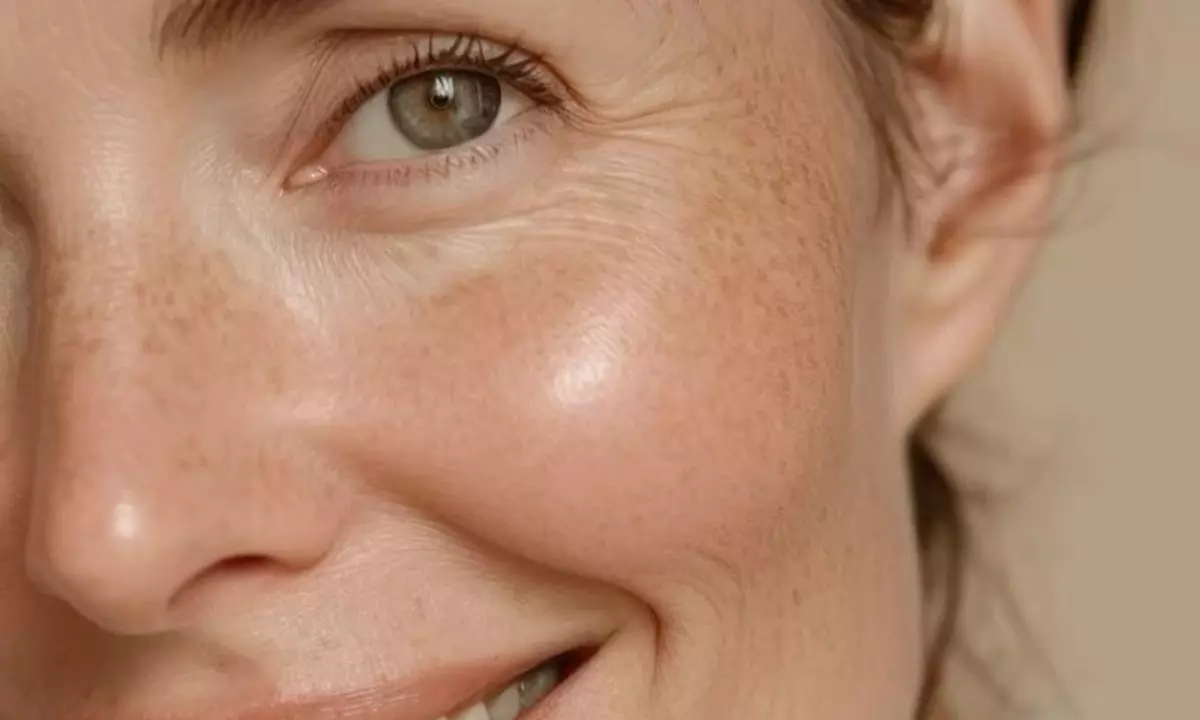 Tratamiento reafirmante inyectado efecto lifting en zona a elegir