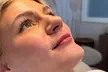20, 40 or 60 Units of Botox or 1 ML Syringe Versa at Logica Aesthetics (Up to 35% Off) - Second Medium
