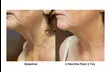 Experience Rewind Advanced Aesthetics'  Skin Tightening for Stomach, Eyes, Neck, or Knees (Up to 30% Off) - Second Medium